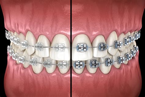 metal brackets vs ceramic brackets|cost of clear ceramic braces.